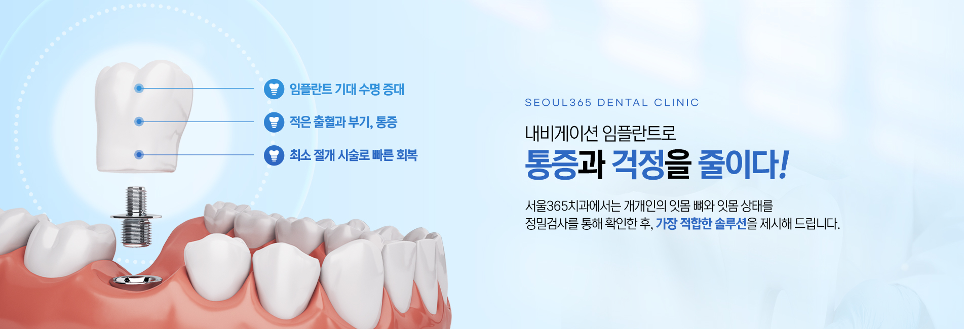 내비게이션 임플란트