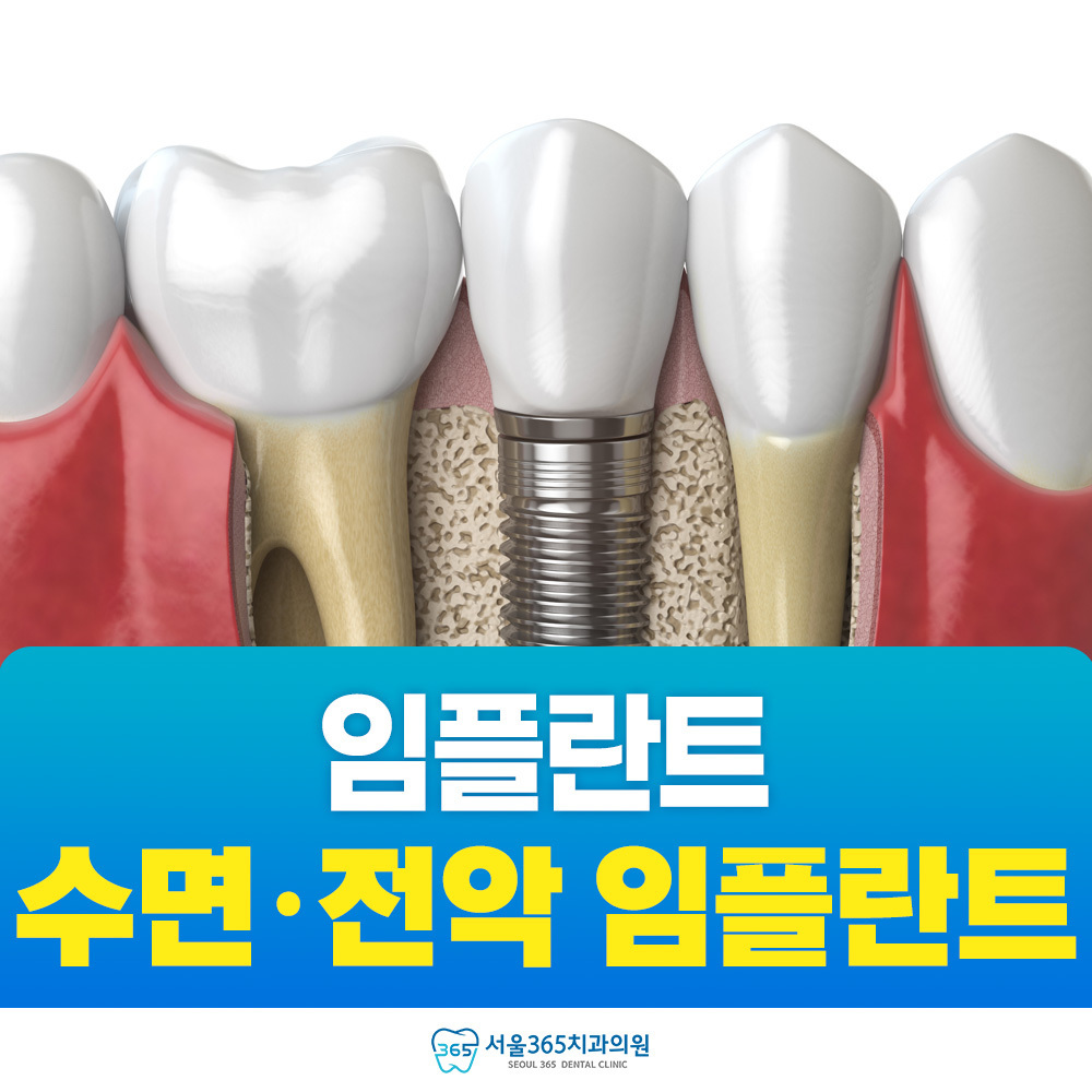 수면 임플란트부터 전악 임플란트까지